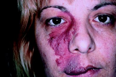 Mancha en vino de oporto antes del tratamiento.Troilius, Agneta. Dermatologic Therapy 2000, 13 (1), 17-23.