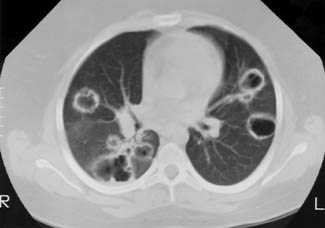 TAC de paciente con enfermedad de Wegener que muestra el desarrollo de mltiples cavidades pulmonares (harrisononline.com)