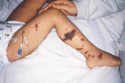 purpura palpable en paciente con sepsis meningoc�cica (JAAD nov 2000)