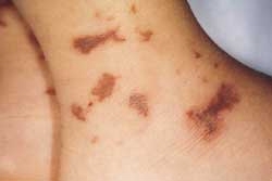 purpura palpable en paciente con sepsis meningoc�cica (JAAD nov 2000)