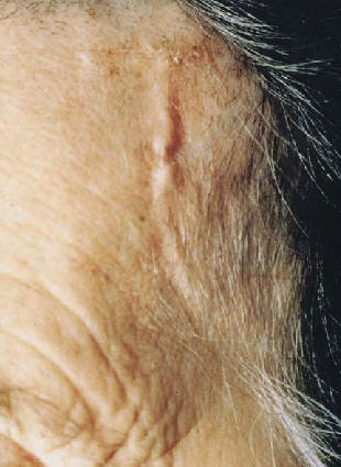 Arteria temporal de un paciente con arteritis de clulas gigantes. El examen clnico de la rama anterior de la temporal muestra una arteria engrosada, nodular y dolorosa. Salvarini C y col NEJM 2002 347:261.