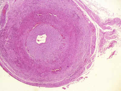 la biopsia de la arteria temporal most una disminucin marcada de su luz con proliferacin de la ntima y infiltrado inflamatorio linfocitario y macrofgico afectando a la media. Asi como presencia de proliferacin capilar en el tercio externo de la intima.