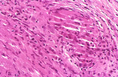 arteritis temporal. Presencia de infiltrado inflamatorio granulomatoso con células gigantes en la pared arterial.