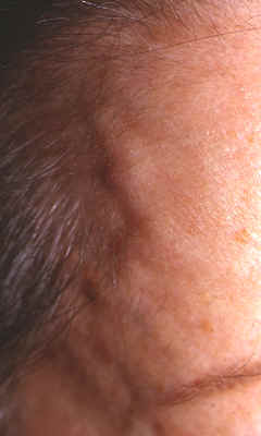 paciente con arteritis temporal. En el momento del diagnstico se apreciaba una arteria temporal engrosada, multinodular y sin pulso (lado derecho)