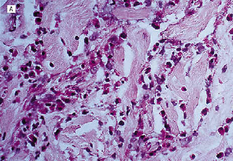 El examen histolgico mostro un denso infiltrado inflamatorio compuesto predominantemente por eosinfilos. Termer CC et al. Arch dermatol 2001, 137:136.