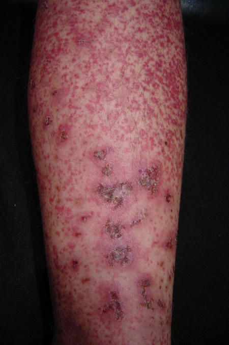 Lesiones de vasculitis leucocitoclstica en diferentes estados de evolucin.