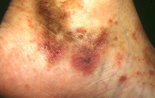 lesiones de prpura palpable con reas de necrosis central
