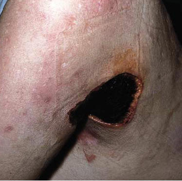 Area de infarto cut�neo en region axilar en un paciente con poliarteritis nodosa (provost TT. Cutaneous medicine)