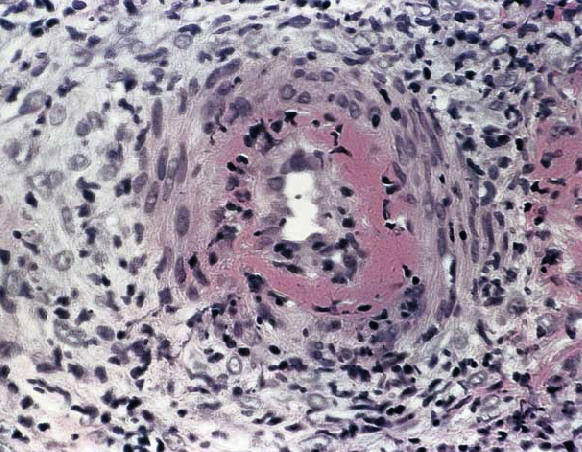 Vasclitis de arteria muscular en la uni�n dermo-hipod�rmica en un paciente con poliarteritis nodosa. Se observa la presencia de infiltrado en la pared del vaso y de necrosis fibrinoide(provost TT. Cutaneous medicine)