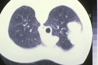 ndulo pulmonar en la enfermedad de Wegener