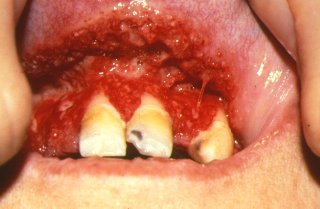 lesiones granulomatosas en encias de la enfermedad de Wegener