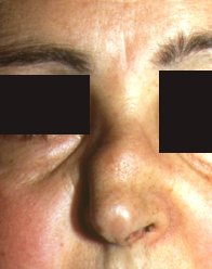 deformacin nasal en silla de montar de la enfermedad de Wegener