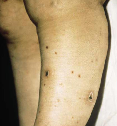 Lesiones de vasculitis en miembros inferiores en una paciente con granulomatosis de Wegener (Provost TT. Cutaneous medicine)