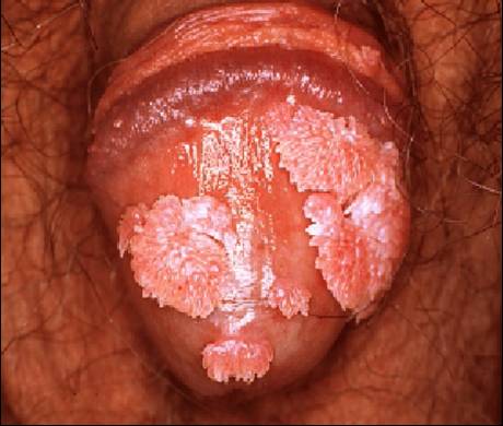 Condilomas acuminados