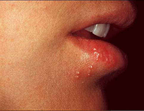 Herpes simple labial recurrente