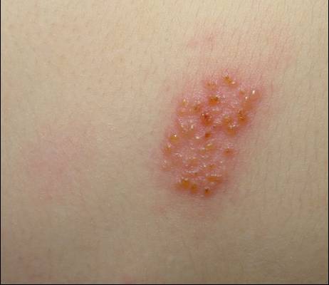Grupo de vesculas de una erupcin de Herpes Zoster