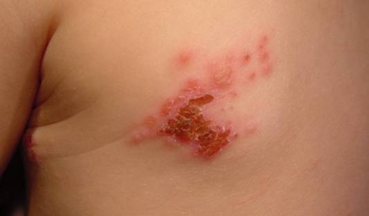 Herpes Zoster en un nio