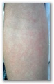 rash reticulado en extremidad superior
