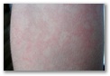 Detalle del rash reticulado