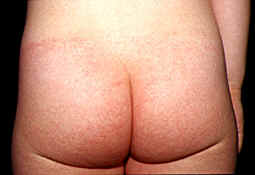 eritema perianal desarrollado a las 24 horas de una faringitis bacteriana