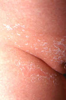 El eritema perianal cura dando lugar a una descamaci�n difusa en la zona afecta