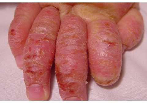 Dermatitis atopica impetiginizada