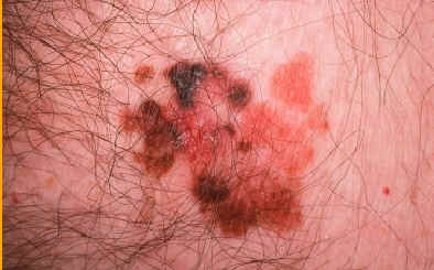 caso 1. (atlas de dermatologia JM: Lachapelle. UCB)