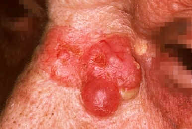 caso 2. JM. atlas de dermatologa. UCB