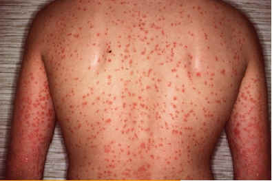 caso 3a. Atlas de dermatologa. UCB