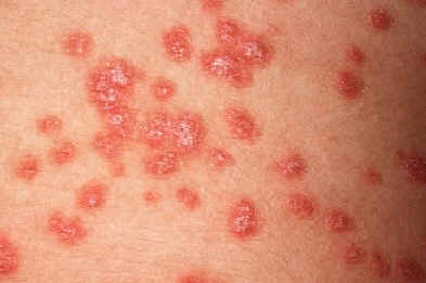 caso 3b. atlas de dermatologa. ucb