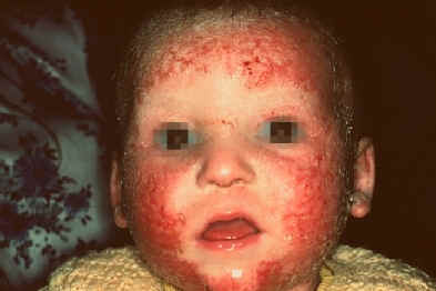 caso 7. atlas de dermatologia. ucb