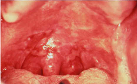 lesiones en la mucosa oral