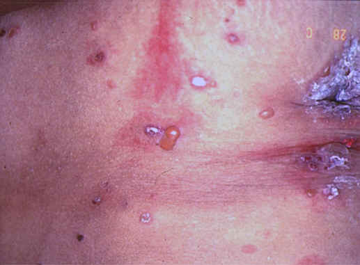 lesiones en tronco