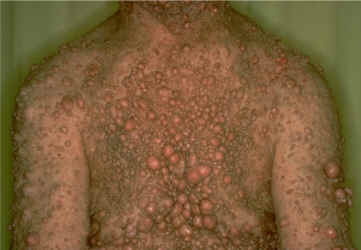 Neurofibromas mltiples, neurofibromatosis. (AAD)