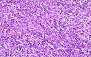 magen histolgica del sarcoma de Kaposi
