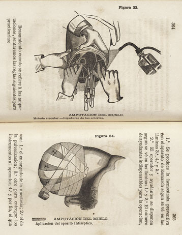 Procedimiento para la amputacin de la pierna con antisepsia