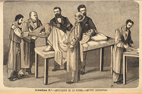 Amputación de una pierna practicada por Enrique Ferrer Viñerta