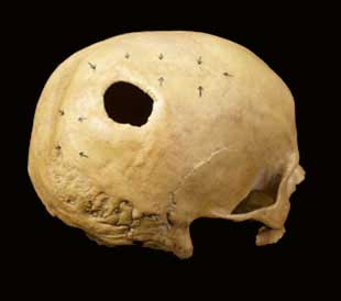 Trepanacin en parietal derecho, por abrasin, con supervivencia