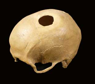 Trepanacin en parietal izquierdo, por abrasin, con supervivencia