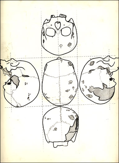 Craneogramas que muestran la situacin de las 15 lesiones visibles en su exocrneo