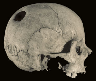 Trepanacin en parietal derecho, por abrasin, con supervivencia