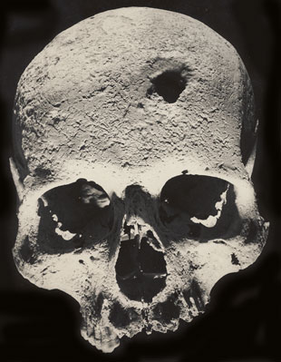 Trepanacin frontal, por barrenado, con supervivencia