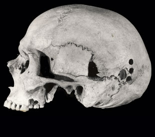 Trepanaciones pstumas en parietal izquierdo, por barrenado