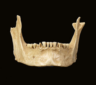 Mutilaciones dentarias pstumas