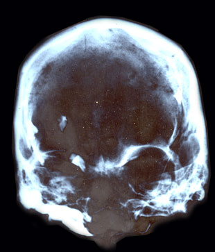 Prdida de sustancia sea en parietal izquierdo