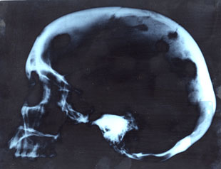 Lesiones mltiples por neoplasia maligna