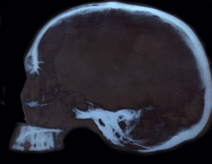 Prdida de sustancia sea en parietal izquierdo