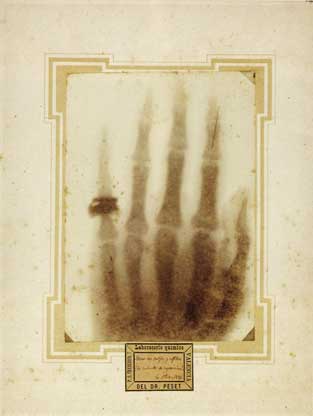 Radiografa por V. Peset Cervera, 1896. 