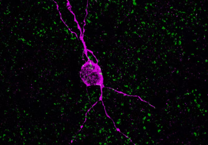 Neurona immadura en una dona de 60 anys. Foto: Simona Coviello.