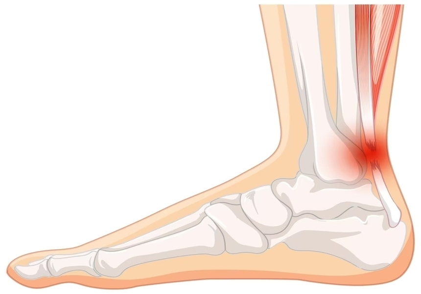 Tendinopatia